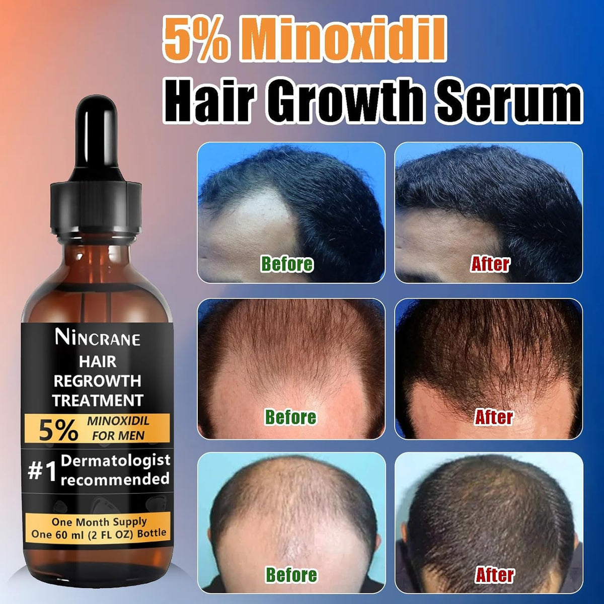 Kit De Crecimiento De Barba Y Crecimiento Del Cabello De Minoxidil Al 5%