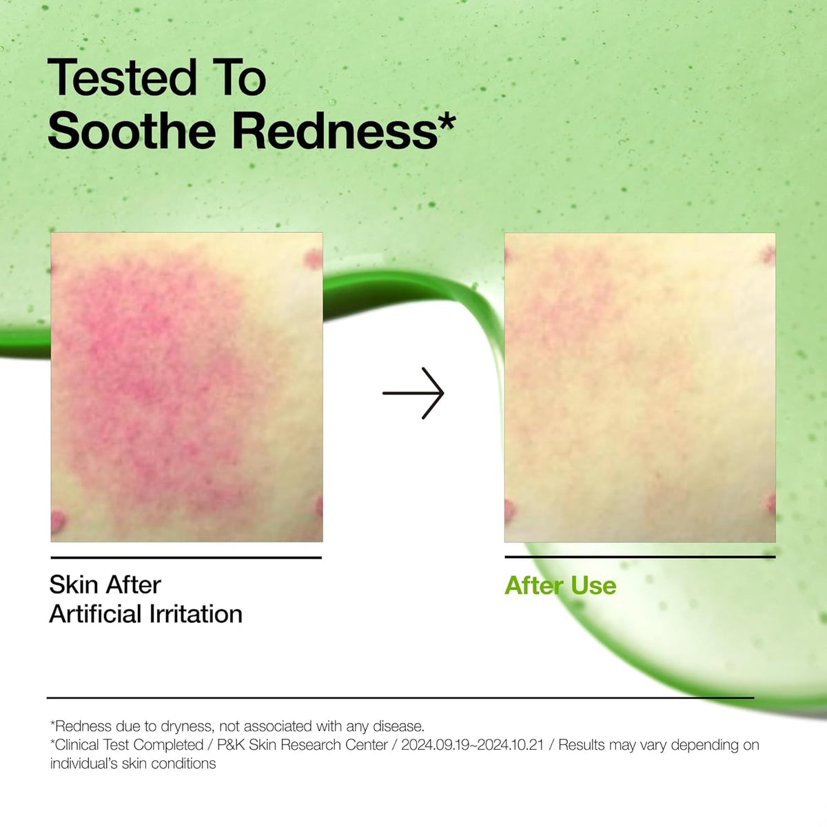 Azelaic Acid 10 Hyaluron Redness Soothing Serum, Facial Serum for Sensitive Skin, Hyaluronic Acid, Niacinamide, Spot Care, Natural Color, Vegan, Korean Skincare (30Ml/ 1.01 Fl Oz.)